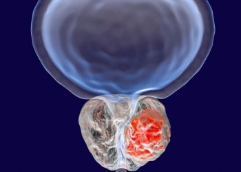 پروستات شایعترین تومور خوش خیم در مردان