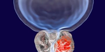 پروستات شایعترین تومور خوش خیم در مردان