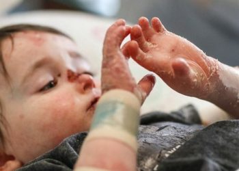 ۸۰ درصد بیماری‌های نادر، ژنتیکی است