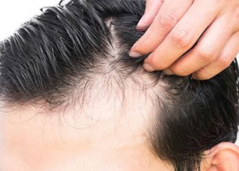 علت ریزش مو در بهبودیافتگان کرونا