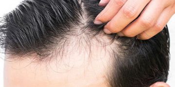 علت ریزش مو در بهبودیافتگان کرونا