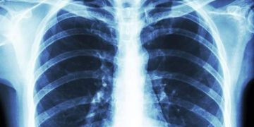 ریه بیماران کُرونایی به حالت عادی بر می گردد؟