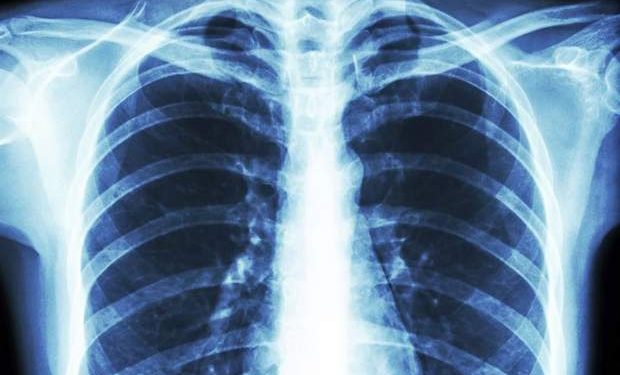 ریه بیماران کُرونایی به حالت عادی بر می گردد؟