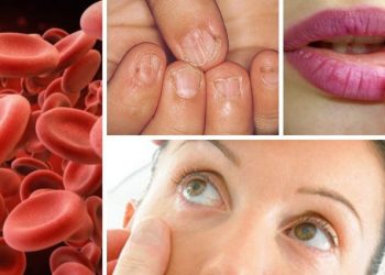 علت و علائم کم خونی فقر آهن