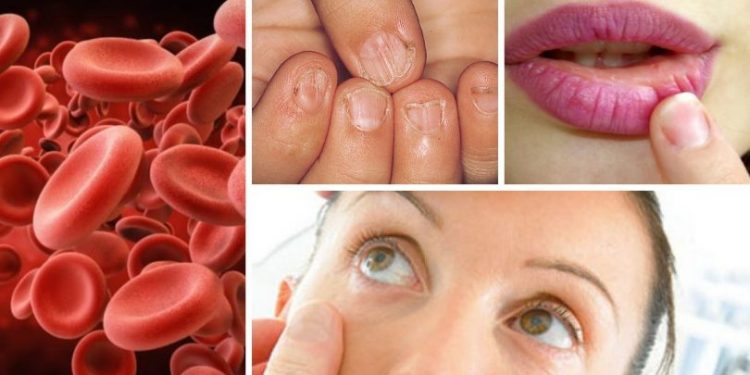 علت و علائم کم خونی فقر آهن