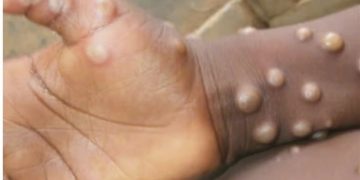 وحشت دنیا از یک بیماری ناشناخته/ همه چیز درباره آبله میمونی!