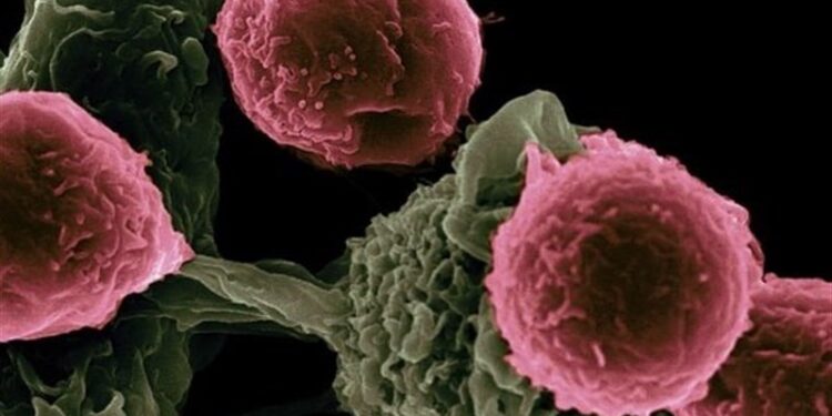 معرفی شایعترین سرطانها در گیلان