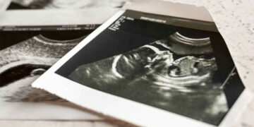 سالانه بیش از ۴۰۰ هزار سقط جنین در ایران