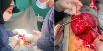 خارج کردن تومور شکمی از بدن کودک ۱۰ساله در مرکز آموزشی و درمانی ۱۷ شهریور رشت