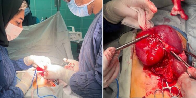 خارج کردن تومور شکمی از بدن کودک ۱۰ساله در مرکز آموزشی و درمانی ۱۷ شهریور رشت